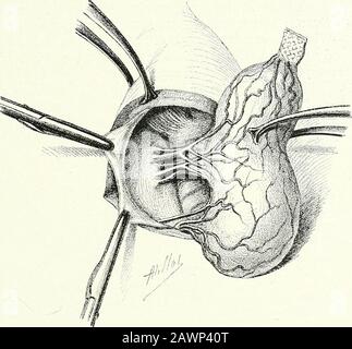 Chirurgische Therapeutika und operative Technik . Abb. 339.-Thyroidektomie: Zerkleinerung des Superior-Pedicle. OPERATIONIS AM HALS 203. Abb. 340.-Thyroidektomie: Bildung des Medianen Pedicle, Stockfoto