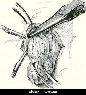 Chirurgische Therapeutika und operative Technik . Abb. 338.-Thyroidektomie.Vierte Stufe: Enukleation des Tumors und Bildung des überlegenen Pedicle. Abb. 339.-Thyroidektomie: Zerkleinerung des Superior-Pedicle. OPERATIONIS AM HALS 203 Stockfoto