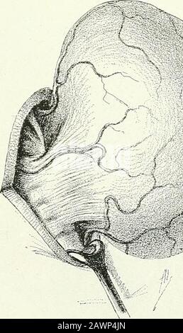 Chirurgische Therapeutika und operative Technik . Abb. 336.-Schema der H-Emostase in der Extraglandulären Enukleation. Es reicht aus, die anatomischen Gefäßpedikel zu binden, nachdem sie sie quiteclose in das Schilddrüsengewebe eingedrückt haben. Der beträchtliche Abstand, der die Einblechung vom rezidivierenden Nerv trennt, wird bemerkt. Abb. 337.--Einseitige Thyroidektomie.Vierte Stufe: Bildung eines einzigen Pedicle. 202 CHIRURGISCHE THERAPEUTIKA UND OPERATIVE VERFAHREN Stockfoto