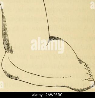 Traité des maladies de l'enfance . Abb. I. - Éléphantiasis des extrémités inférieures. Lespace interscapulaire; on sentait des ganglions dans laisselle. Peau lisse, adhérente, sans changement de couleur, sans modification de la température.lymphangit au niveau de la main. Le membre gauche était normal; Cepen-dant il y avait, dans Faisselle de ce côté, une Masse ganglionnaire analogueueà celle du côté droit. ELEPHANTIASIS. 221 4 dès Une fillette de 14 mois, de parents sains ef blancs, a présenté   sanaissance un Volume énorme des pieds (Abb. 4). UN médecin a voulu pra-tiquer une légère incision q Stockfoto