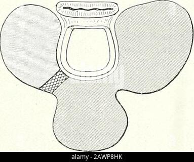 Chirurgische Therapeutika und operative Technik . Abb. 317.-Ukilateral Parenchy-matous Goitre. Abb. 318.-Median Parenchy-matous Goitre.. Stockfoto