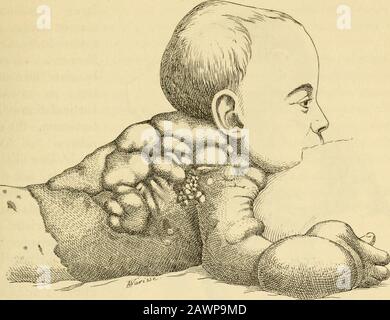 Traité des maladies de l'enfance. Sent avec peine; ce nest pluslérysipèle, mesz le lympangiome diffus et chronique. Symptomes Laissant de côté les tuméfrations éléphantiasiques qui succèdent auxlésions cutanées, à lérysipèle à Répétition, à loedème, aux angiomes vul-gaires, nous étudierons spécialement, au point de vue clinique, léphantiasiscongénital, dont observations se sont multipliqueséquéqueséquéquéquéléées. Für die Beschreibung plus intéressante plus frappante, nousrapporterons les faits plus topiques avec quelques dessins destinés à lesgraver dans lesprit du lecteur. Vo Stockfoto