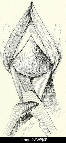 Chirurgische Therapeutika und operative Technik . Abb.^298.-man(EuyKE VON DivuLSiON. ^^^ 299.-Man(euvke of Divulsion:Die Schere^wurden hinter Der Schnürung des Hinterleidens und des Flands eingeführt. Inferiore Zelladhäsionen. Stockfoto