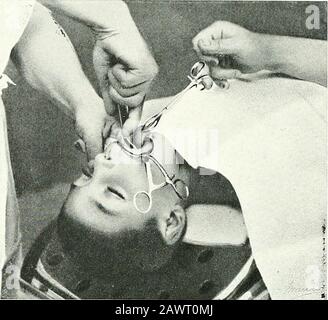 Chirurgische Therapeutika und operative Technik . Abb. 245.-Diagrammatische Abbildung, die die Position auf der Raspatory im Moment zeigt, in dem sie die Pedicle des Polypus von der : tsSeat op-Implantation auf der Basilaren Apophysis entfernt. 134 CHIRURGISCHE THERAPEUTIKA UND OPERATIVE VERFAHREN. Abb. 246.-Extirpation einer Mittelgroßen Naso-PhaktngRVL-Polypus. Abkoppeln mit der Raspatorie des Pedicle von seinem Sitz der Implantation auf der basilaren Apophyse. Stockfoto