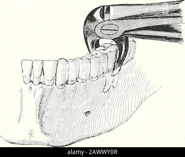 Chirurgische Therapeutika und operative Technik . Abb. 142.-Entfernen des Ersten Loweb Molak. Die gleiche Pinzette wird für beide Seiten verwendet. Die dunkle Linie weist auf den ersten Griff hin, die andere auf den unteren. Bei den Pinzetten Nr. 9 (zweiter Molarand Weisheitszahn unten links) und Nr. 10 (entsprechende Zähne der rechten Seite) befindet sich die obere Klinge im Zahnauffall etwas anteriorto links. V. Abb. 143.-Entfernen des Letzten unteren Molars auf Der Linken Seite.Die dunkle Un©-Anzeige zeigt den Drsfc-Griff für Lusatioa des Zahnes an. Wenn wir in der Rose-Position mit dem Kopf nach hinten drehen, können die Unterzähne Stockfoto