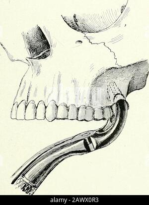 Chirurgische Therapeutika und operative Technik . Abb. 139.-Extraktion eines Linken oberen Molars. Die diagrammatische Skizze zeigt beim ersten Griff des Zahns, durch den er Luxation hat, und bei 2 den zweiten Griff für die Extraktion. Bei den ersten Molaren ein wenig nach links oder rechts, Und legt sich im Fall des unteren Molaren und der Weisheit links oder rechts des Patienten an. Stockfoto