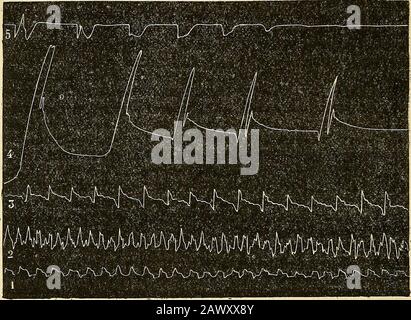 Comptes rendus des séances de la Société de biologie et de ses filiales . représente dail-leurs de faibles pulsations, mais assez régulières chez un Animal, dha-bitude très émotionné en pareille circonstance, aux lignes qui succèdentà labilption progressive du poison, nconstations plus modificons plus a modifictions. très coïncidant avec une augmen-tation accusée de leur amplitude et une irrégularité persistante; puis , àla Suite daccès convulsifs, qui sexpriment sur le graphique par unetension subite et l Stockfoto