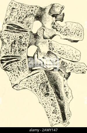 Ein Lehrbuch der Geburtshilfe . Abb. 325.-Spondylolisthese, gut markiert(Schauta]. Abb. 326. - Spondylolisthese, Anfang (Schauta). Stockfoto