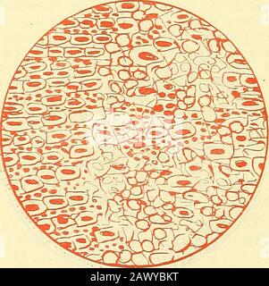 Narkologie : ein Handbuch der Wissenschaft über die allgemeine und lokale Schlagerei (Narkosen und Methoden der lokalen Anasthesie) : in 2 Bänden mit zahreichen Abbildern . Leber, das Fett ist aufgelöst, es zeigen sich nur noch Fellbalken mit undeut-lichen Kernen, daneben viel Blutkörperchen und Zerfall, freie Kerne undschollig zerfallenes Protoplasma. Leber nach zvpei Chloroformnarkosen. Fiffur 97.. Leber mit Nekrose und Zerfall der Leberzellen nach Chloroformnarkosen. Stellenvreis finden sich noch erhaltene Leberzellen, daneben Detritis, freie Kerne, Blutkörperchen, abgestorbene Zellen. Stockfoto