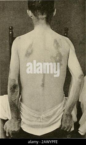 Die endemischen Krankheiten der Südstaaten . Abb. 80.-Extensive Dermatitis von Armen und Füßen. (Dr. T. E. Sanders.) um den Hals parallel zum Unterkiefer und von ihm abtrennbare Finger. Die beiden Linien treffen sich auf einer Höhe über dem Kehlkopf. Die untere Grenze soll ein wenig sein - 334 ENDEMISCHE KRANKHEITEN DER SÜDSTAATEN tief den Wirbel markant, gehen um die Wurzel des Halses auf beiden Seiten und vereinigen sich über den oberen Teil des Manubriums. Der pellagrose Ausbruch der Füße ist von ziemlich häufigem oc-. Abb. 8i.-Rückseite des gleichen Patienten wie in Abb. 80. Aktuell. Das tun Stockfoto