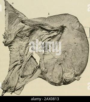 Die Pathologie und chirurgische Behandlung von Tumoren . ed-the tiibceapcrtcc und tubce occliisce von Froriep. Da der Verschluss des distalen Rohrendes in der Regel von Adhäsionen erfolgt, die durch eine Peritonitis des Beckens entstehen, IST DIES ZU 10 TRION- C YS TS. 665 die Zuneigung ist häufig bilateral, wie es bei Pyosalpinx der Fall ist. Thelumen des Tubus auf der Gebärmutterseite in einem normalen Zustand ist quitesmall; häufig wird es durch die katarrhalale Salpingitis eingeengt, die die Peritonitis vor sich führt, oder das Ausweichen des Tubalkresekrets wird durch einen Valvularverschluss der Öffnung verhindert. Die bei weitem häufigste Ursache für katarrhale Salpin Stockfoto