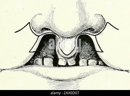 Chirurgische Therapeutika und operative Technik . Abb. 18.-Einfaches Bilaterales Hare-Lip. Verschieben der seitlichen Klappen und Koaptation. Stockfoto