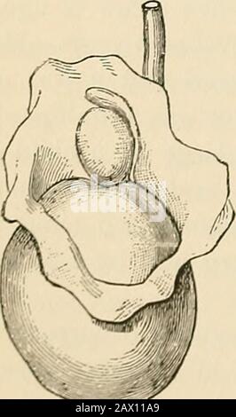 Pathologie und chirurgische Behandlung von Tumoren. Bodensubstanz. (Vergrößerung wie in Abbildung 434.) die Tunica albuginea hat stattgefunden, der Tumor wächst veryrapide. Eine Verlängerung entlang der Spermaschnur führt zu einer schnellen und extensiven regionalen Infektion. Die Metastasierung geht der tödlichen Beendigung sehr gut voraus. Veryoft erscheint die gleiche Zuneigung im Gegensatzetetikel. Bei der differentiellen Diagnose des Sarkoms des Thetestikels ist es wichtig, Karzinom, Knollenkulose, Gumma und Hämatokele auszuschließen. Abbildung 436stellt ein Sarkom des Hodens dar, das bei einem Kind an drei auftritt Stockfoto