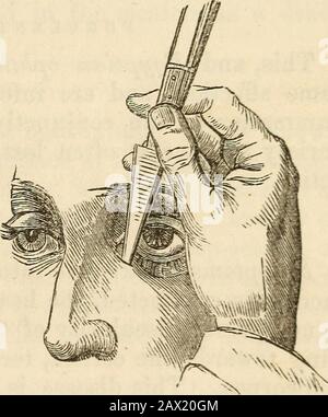 Ein Handbuch der Chirurgie: Mit fünfzig Abbildungen. Perture am inneren Augenrand, das Ergebnis einer Burstingvon einem Abszess verursacht j Obstruktion.Die Entzündung des Sacks wird durch Laugen und kalte ap-Anwendungen behandelt. Wenn die Suppuration ausklinkt, soll der Tumor aufgebüscht werden, sobald er sich verändert hat. Die Öffnung sollte parallel zum Orbit und unterhalb des Thetendon des Orbicularis erfolgen. Thesac sollte dann gründlich gereinigt werden, und nach einenTagen, falls Zweifel bestehen, mit Bezug auf die Pervioität der Röhren aud sac, ein Explt Stockfoto