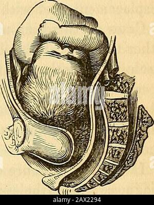 Eine theoretische und praktische Abhandlung über die Mittelwiferie: Einschließlich der Erkrankungen der Schwangerschaft und Geburt und der vom Kind von der Geburt bis zur Entwöhnungszeit benötigten Attentionen. Form einer Largeblasche, die rechts vom After hängt und bis zum Bein absteigt. InOne von den von Smellie beobachteten Fällen wurde der Tumor, der gegen Ende der gesta-aktion so groß war wie die Faust, seltsam und gangrenös. Der Sitz des Tumors, der sich immer im unteren Teil der Großlabie befindet, zwischen dem Rand des Anus und der Tuberosität des Ischiums, der Leichtigkeit, mit der er wieder verbunden ist Stockfoto
