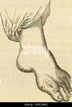 Ein Handbuch der Chirurgie: Mit fünfzig Abbildungen. Entweder entfernt oder durchgesägt. Die überlegene Klappe wird vor der Unartikulation und die untere anschließend hergestellt. AMPUTATION DES GROSSEN TOE. Die bequemste Art, diesen Zehenbereich zu entfernen, ist die durch gestrichelte Linien in dieser Abbildung dargestellte Schneide. Beginnend an der Innenseite des Metatarsalknochens und[Abb. 41. Das Gelenk schräg umlaufen und dabei darauf achten, dass die Arteria anteriortibialis nicht gewickelt wird. Die Klappe ist von der Zehenaußenseite aus gefertigt. Er deckt den Kopf des Metatarsalkbonemors perfekt ab und kann rea-dily erhalten werden Stockfoto