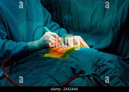 Der lunge Chirurg und team Thoraxchirurgie in Lungenkrebs durchführen Stockfoto