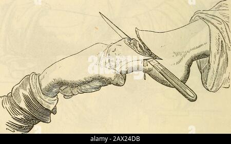 Ein Handbuch der Operation: Mit fünfzig Abbildungen sollte man dem Niesen nicht näher ampuieren, als die Tuberosität der Tibia, oder das Gelenk wird geöffnet, und es kommt zu Entzündungen. Daher ist die Amputation beim Hnee selten pro Form, obwohl die Disartikulation leicht mit dem Skalpell der Alarge durchgeführt werden kann. Bei dieser Operation sollte die Patella toremain zugelassen werden. AMPUTATION DES FUSSES. Der Fuß ist an zwei Stellen amputiert. CHOPARTS-BETRIEB. Aus dem oberen Teil der Stufe wird eine Klappe gebildet, und die Entarti-Berechnung begann unmittelbar hinter der Tuberosität des sca-phoiden Knochens. Das Bistüro ist vorbei Stockfoto