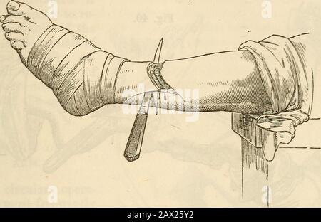 Ein Handbuch der Chirurgie: Mit fünfzig Abbildungen . Stumpf wird in gewisser Weise von der Art der zu verwendenden künstlichen Extremität abhängen. Wenn der Patient auf dem Zischnee ruhen soll, sollte der Stumpf kurz sein, um im rechten Winkel gebogen zu werden. CIRCIILAE-METHODE. Der Tourniquet, der angewendet wurde, die ganzen Instrumente sollen geteilt, zerschnitten und um zwei Zentimeter zurückgedreht werden; die Musklesare sollen durch einen zweiten kreisförmigen Einschnitt bis auf den Knochen geteilt werden.Dann soll ein catlin zwischen den Knochen geführt werden, um das interossäre Ligament und die Muskeln zu teilen; Anschließend wird ein Dreiwegeaufroller aufgetragen, ein Stockfoto