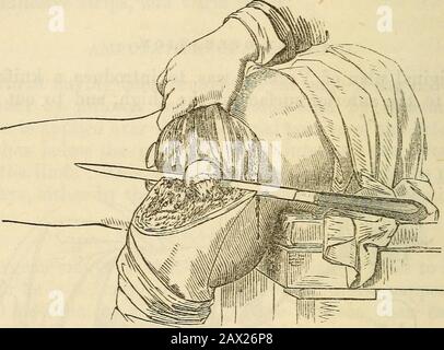 Ein Handbuch der Chirurgie: Mit fünfzig Abbildungen . E gemacht durch das in-Serten des Messers an der Seite des Oberschenkels, wie in Abb. 37, statt dessen die anteriore Oberfläche. Die Einwände gegen die Klappenoperation sind Verletzungen von Gefäßen und Nerven durch Kreuzigung und schräge Divi-Version. AMPUTATION AM HÜFTGELENK. Diese Operation ist selten notwendig und immer schwerwiegend und donnenartig; sie sollte niemals bei Gelenkerkrankungen durchgeführt werden. Thepatient soll auf einen Tisch gelegt werden, wobei sein Becken von der Kante abragt. Die Arterie wird von einem Assistenten zusammengedrückt, der bergab sein muss, um seine Finger in das w zu drücken Stockfoto