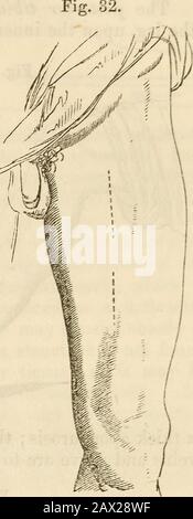 Ein Handbuch der Chirurgie: Mit fünfzig Abbildungen . der sartoriusmuskel, im oberen Teil des Oberschenkels, nach Scarpa, wo die Arterie issuperficial. Die Vena saphena soll in der Dissektion der Oberflächialfaszie neu garniert werden. Nach dem Öffnen der Ummantelung wird Karemust genommen, um die Vene nicht zu verletzen, norto den Nervus saphenus eingeschlossen. Die Operation des Jägers^ist etwas unterhalb, und in der Übereinstimmung muss der sartorius teileroder zur Seite geschoben werden.-Der vordere Tibialar-tery kann an mehreren Stellen gebunden werden: Am oberen Teil des Beins, durch einen freien Schnitt, soas, um zwischen den Tibialis anticus andexte zu gelangen Stockfoto