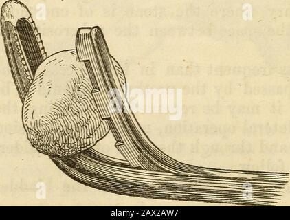 Ein Handbuch der Chirurgie: Mit fünfzig Abbildungen. Die anderen, die Extremitäten sind leicht gebogen. Es kann als Schall oder Katheter in die Blase eingeführt werden, danach wird das Bladesare abgetrennt, um den Stein zu fassen. Im Originalinstrument wurde die Klinge mit einem Hammer geschlagen, und damit war der Stein zerbrochen; jetzt ist die Brechkraft die einer Schraube, variouslyadaptiert, die von Herrn Weiss am einfachsten und perfektesten ist. Die Extremitäten des Instruments haben Zähne, um den Stein beim greifen zu halten, und Abb. 27. Auch Fenestrge, um das Ausweichen von Sand oder Pfandstein zu ermöglichen. Die Patie Stockfoto