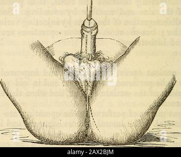 Ein Handbuch der Chirurgie: Mit fünfzig Abbildungen. Er hat die Linie der Zeichnung gegosst (Abb. 24), von etwa drei Zoll Länge, beginnend etwa einen Zoll hinter dem Hodensack, und nach unten und außen bis zu einem Punkt zwischen dem Anus und der Tubero-Sity des Ischiums und sogar darüber hinaus verlängert. Verschiedene Messungen werden von verschiedenen Chirurgen an dem Punkt gegeben, an dem dies verfestigt werden soll. Kein gut informierter Chirurg sollte aufgrund der Unterschiede, die bei indifferenten Patienten auftreten, abhängig von der Größe und Tiefe des peri-neums sein. Er sollte sich darüber informieren Stockfoto