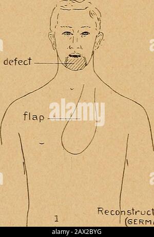 Status der plastischen Chirurgie über Ohr, Gesicht und Hals . aufgerollt Flapin anstelle von Backendefekt Rekonstruktion von Niederkiefernum^ Kiefer(SERMA,N ME-thod)! Abb. V. Stockfoto