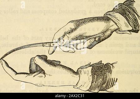 Ein Handbuch der Chirurgie: Mit fünfzig Abbildungen . Kommunikation mit 84 OPERATIONEN. Der Darm, öffnet sich auf den Naten; wenn er nicht mit dem Darm kommuniziert, sondern sich nach außen öffnet, spricht man von einer blinden Externalfistel; wenn er sich nach innen öffnet, aber nicht nach außen, spricht man von einer ablinden inneren Fistel. Wenn sie vollständig ist, wird Eiter, Feeces und Wind entladen, und sie wird mit Hitze, Unbehagen und Schmerzen beaufsichtigt. Der Sinus ist manchmal sehr gewunden und oft mehrlokuliös. Die interne Öffnung befindet sich etwa eineinhalb Zentimeter über dem Anus, aber manchmal höher. Die Ursache, die sie verursacht, kann variieren. Es Stockfoto