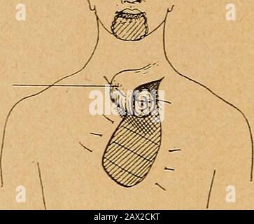 Zeigen Sie den Status einer plastischen Operation an Ohr, Gesicht und Hals an. Abb. IV 14 B^CK: Status OE PLASTISCHE CHIRURGIE. Haben das Wappen des illium bevorzugt an der Anteriorgrenze der Tibia eingesetzt (Rysdon sagte, dass sie mehrere Fälle von Frac-turen der Tibia nach Entfernung der Teile derselben hatten). Myidea ist, dass es wahrscheinlich auf eine sekundäre Rarifosteitis zurückzuführen war, die die Fraktur verursachte, anstatt dass zu viel entfernt wurde. Bei der Verwendung von Knorpeltransplantationen ist eine sehr praktische und neuartige Idee die Resektion mehrerer Stücke von costalem Knorpel, aber vielleicht nur Klappe aufgerollt. Stockfoto