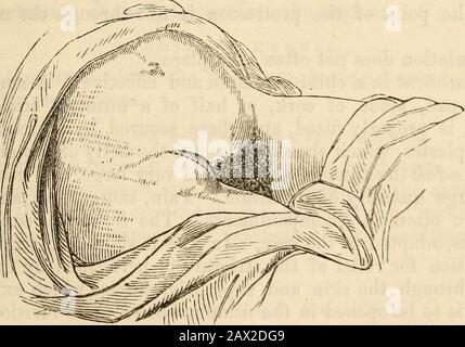 Ein Handbuch der Chirurgie: Mit fünfzig Illustrationen . Ich. Es wird keine kremasterische Bedeckung geben, sondern anstelle einer itan-Expansion der zusammengefügten Sehne der inneren schrägen andtransversalis-Muskulatur; manchmal ist dies aufgrund der Spaltung der Zehnerkartusche, insbesondere wenn die Überdringung plötzlich ist, und der Folge großer Gewalt. Bei einer verdeckten Leistenhernie muss die Sehne der äußeren Schräge geteilt werden, ebenso der untere Teil der inneren Verflüssigungs- und Transversalismuskulatur. FEMORALHERNIE. Dies ist bei Frauen am häufigsten, aufgrund der natürlichen Form des Beckens. Der Abstieg Stockfoto