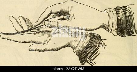 Ein Handbuch der Chirurgie: Mit fünfzig Abbildungen . und dem Inhalt des SAC enttarnt; die Faltung oder der Knöchel des Darms werden je nach Zeitraum und Intensität seiner Würgebewegung zwischen einer hellroten und einer tiefen Schokoladenfarbe variieren; Sehr oft zeigt das Testin Flecken auf seiner Oberfläche, wenn die Entzündungen intensiv waren. Der Finger soll dann zur Untersuchung des Strengungspunktes eingeführt werden; sollte keine vorhanden sein, sollte ein Reduktionversuch unternommen werden, wenn sich der Darm in einem ordnungsgemäßen Zustand befindet. Thestriktur erkannt, ein sondenspitzer Bist Stockfoto