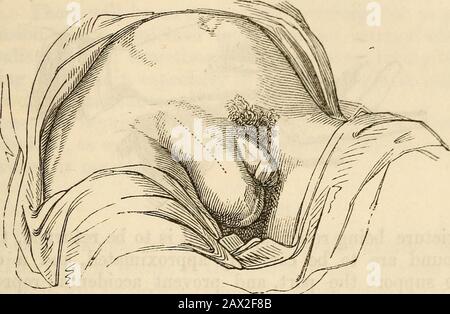 Ein Handbuch der Chirurgie: Mit fünfzig Abbildungen . die Verrung repräsentiert diesen Teil der Parieten des Abdomens. Der Tumor in dieser Sorte ist näher an den Symphysispubis und befindet sich auf der Innenseite der Arteria epigastrica, während der Tumor bei inder indirekten Varietät auf der äußeren Seite der Arteria epigastricus liegt. Verdecktes Leistenhernial^ ein Begriff, der auf einen Vorsprung angewendet wird, der im Leistenkanal festgehalten wurde. Die Operation zur Wiederentartung der Stricture in einer indirekten Leistenhernie muss durchgeführt werden, indem der Patient auf den Rand des Eßbaren gestellt wird, wobei jeder Fuß auf einem Stuhl ruht; das sur Stockfoto