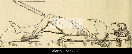 Ein Handbuch der Chirurgie: Mit fünfzig Abbildungen . ist von der Nackensäure des Knochens durch die Position des Fußes und die Therigidität der Extremität zu unterscheiden. Die Reduzierung ist die schwierigste aller Vertreibungsversuche und sollte so bald wie möglich nach dem Disphicoment versucht werden. Wenn er nicht produziert wird, passt sich der Kopf des Knochens an seine aktuelle Position 60 AN. Durch die Bildung einer neuen Höhle kann der Patient nach und nach^ die Zehen gehen, die nur den Boden berühren. Blutungen, Awarmbad und Tataremetikum müssen verabreicht werden, so der Patient^Constitut Stockfoto