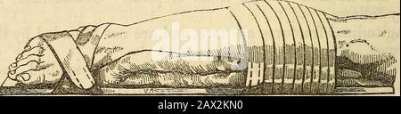 Ein Handbuch der Chirurgie: Mit fünfzig Abbildungen . näher am Knöchel, kann Verortung produziert werden. Der frequentseat von Fractuxe liegt zwischen zwei und drei Zoll über dem Malleolus. Es gibt sofortige Klagen; der Fuß ist herausgedreht; Krepitus ist undeutlich, und über dem zersplitterten Teil existiert eine Depression. Beide Honen werden oft auf einmal durch Stürze oder Schläge zerbrochen; Thoy 6 50 OPERATION. Treten an den schwächsten Stellen auf. Die Anzeichen sind offensichtlich: Krepitus, Schmerz, Bewegungsanwant, &c Es gibt selten eine große Verkürzung, und die Deformität wird leicht reduziert. Behandlung: Wenn beide Knochen zerbrochen sind, wenn die Tibia Stockfoto