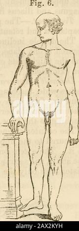 Ein Handbuch der Chirurgie: Mit fünfzig Abbildungen . nzu dieser unkellierten Struktur der anderen, die eine betroffene Fraktur darstellt;in diesen Fällen ist Krepitus obskur, die Verschiebung ist gering, und es gibt beträchtliche Kraft und Bewegung der Extremität, und aber Littleshorgation und Eversion. Sie werden von großer direkter Kraft produziert und mit großen Schmerzen, Schwellungen und Verfassungsstörungen begleitet. Die Behandlung kann in vielen Fällen ohne die Verwendung von Splints erfolgreich sein. Der Trochanter Major kann zerbrochen sein; der Prozess wird von den Gluteimuskeln nach oben gezogen, und ein Raum kann betw gefühlt werden Stockfoto