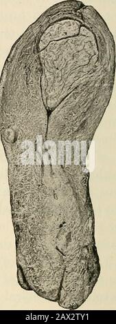 Die Pathologie und chirurgische Behandlung von Tumoren . Abb. 342.^Myom am Modus der Gebärmutter, Abb. 343.-Myom aus Fundus, wachsend inwardwachsend nach außen (nach Winckel): A, vordere Lippe; (nach Winckel). ^.hintere Lippe; c, Uterushöhle; d, Tumor. Stockfoto