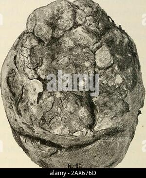 Die Pathologie und chirurgische Behandlung von Tumoren . Abb. 238.-Breite Erosionen der beiden Lippen des Cervix, mit zahlreichen Drüsenöffnungen (nach Winckel). Abb. 239 - Papillarkarlinuma des Cervix begrenzt almostvollständig auf die vordere Lippe (nach Winckel). Geschwür ist ungleichmäßig und hart (Abb. 239). Wenn die Krankheit beide Lipsat gleichzeitig umfasst und im Umfang begrenzt ist, die Öffnung des Zervixes Stockfoto