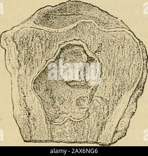 Chirurgie; ihre Theorie und Praxis . Abszess am Ende der Tibia. Die thepyogene Membran ist gut zu sehen. (Vom St. Barthelo-mews Hospital Museum.) 2 24 ERKRANKUNGEN VON SPEZIALGEWEBEN. Abb. 70.. Necrossed Cann-Uous Knochen in Abszesshöhle. (Von ^t. Museum BartholomewsHospital.) kehlt auf Kosten des alten Knochens, es entsteht ein neuer Knochen, der sich so gut wie in den weichen Teilen nur selten auf den Weg zur Thesurface macht. Da der Abszess jedoch das Gelenkgelenk erreicht, bildet sich kein neuer Knochen unterhalb des Gelenkknorpels, und so kann der Eiter, der die Autotilge erreicht, ihn perforieren und in das Gelenk ausweichen. W Stockfoto