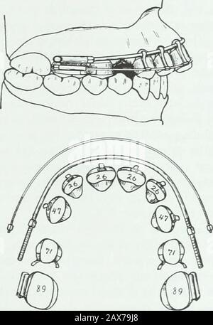Eine praktische Abhandlung über die Technik und die Prinzipien der Zahnorthopedia und der prothetischen Korrektur des Gaumenspalmens. Stockfoto