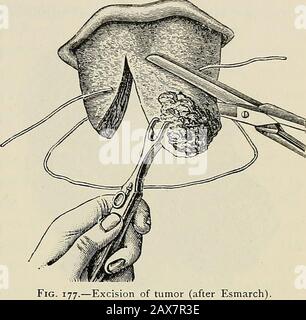 Die Pathologie und chirurgische Behandlung von Tumoren . Abb. 176.-Einlegen der Traktionsnaht (nach Esmarch).. Des Tumors (nach Esmarch). Das Messer oder mit einer Schere. Die Blutung wird leicht kontrolliert, da sie genau saugt. Die tiefen Nähte sollten alle Gewebe umfassen, und wenn es eine Tendenz zur Inversion der Schleimhaut gibt, dies Stockfoto