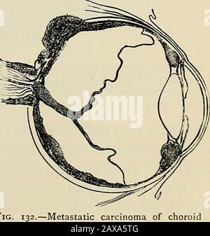 Die Pathologie und chirurgische Behandlung von Tumoren . bei der lokalen, regionalen und allgemeinen Verbreitung wird durch die Migration und den Transport von Zellen verursacht, die aus dem Priniartumor stammen. Die Lunge und die Leber sind die Organe, die am häufigsten das Sitz des metastatischen Karzinoms sind. Wagner von Chicago hat fünfzehn Fälle von metastasiertem Auto-Cinom des Choroids gesammelt und einige interessante Observationsins-Hinweise auf die Art und Weise der lokalen Diffusion der metastasierten Tumoren in dieser Lokalität gemacht. Schnelle lokale Verbreitung des Tumors in dieser Lokalität ap-Birnen zu einem seiner Hauptklinikalmerkmale. In der c Stockfoto