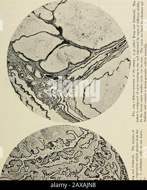 Die Pathologie und chirurgische Behandlung von Tumoren. Gure 103. Proliferöse Zysten des Eierstocks kehren nach der Opern-tion eher zurück als irgendwelche der anderen gutartigen Tumoren. Wenn sich der Tumor von der Oberfläche des Eierstocks entwickelt oder die Operation nach perforierter, proliferöser Zyste verschoben wird, bleiben die Tumorfragmente frequentlysiert. Und aus diesen Fragmenten geht das Rezidiv aus.Wiederkehrende Tumoren haben kein Pedicle und sind in der Regel weitgehend adhärent, was ihre Entfernung schwierig und manchmal unmöglich macht. Wenn Thetumor-Gewebe mit dem peritonalen Surfac in Kontakt kommt Stockfoto