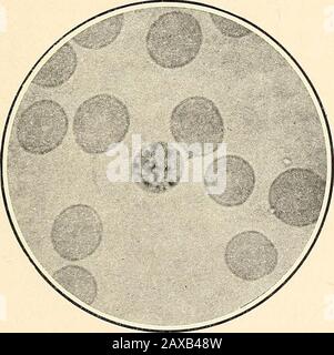 Die Malariafieber, das hämoglobinurische Fieber und das Blutprotozoa des Menschen. Abb. 6.-Plasmodium malarias. (Quartan-Plasmodium.) Präsegmentingparasit. Photomikrograph, X 1200. Regel es gibt nicht so viele Unterschiede in der Größe der sporulierenden Formen von Plasmodium malariae wie es in den gleichen Formen von Plasmodium vivax gibt.Die sternartige Anordnung des Pigments zwischen den Segmenten, die Thayeras so charakteristisch ansieht, wird allgemein beobachtet, aber ich habe genau beobachtet. Stockfoto