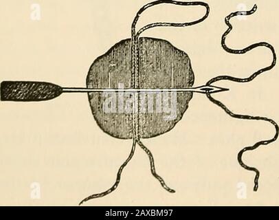 Die Pathologie und chirurgische Behandlung von Tumoren . Abb. 52.-Manecs Methode der perkutanen Ligation eines Tumors (nach Manec). Galvano-ätzenden Draht.-Erkennen der Nachteile der silkand-metallischen Ligaturen bei der Entfernung von Tumoren, Middeldorpf im Jahr 1852. Stockfoto