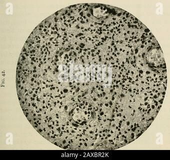 Die Pathologie und chirurgische Behandlung von Tumoren . LG. 40.-Gumma der Leberfhinter Karg und Schmorl). Im Zentrum der fieUl umschriebenen Foci,miliary giimmata: Die gleichen bestehen aus jungem Granulation-Gewebe und zeigen in Tlieir-Mitte evidencesof Degeneration. Die Parenchymzellen werden als gräulich-schwarze Streifen gesehen und von jedem anderen durch schmalere Streifen des zellulären Bindegewebes getrennt. Vorbereitung von geteetteten Gewebebögen von nur geringem Wert für diagnostische purpo.ses. Das Fragment sollte ordnungsgemäß vorbereitet werden, und aus ihm sollten .sections.for micros genommen werden Stockfoto