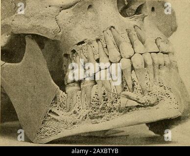 Angewandte Anatomie und orale Chirurgie für Zahnmediziner. Teriorlyis die submaxillare Fossa, die die submaxillarygland enthält, während darüber, vorne, die sublinguale Fossa, für die Unterbringung der untersprachigen Drüse ist. In der themedianischen Linie, auf der inneren Oberfläche, befinden sich die vier Genialtubercles - das obere Paar für die Anbringung der Muskulatur des Geniohyoglossus und das untere Paar für die Muskulatur des Thegeniohyoids; unterhalb der Genialtubercles befindet sich die Fossa für die Anbringung des Musculus digastricus. Direkt vor dem Winkel des Unterkiefers, an dessen unterer Grenze, befindet sich die Gesichtskerbe, durch die PA Stockfoto