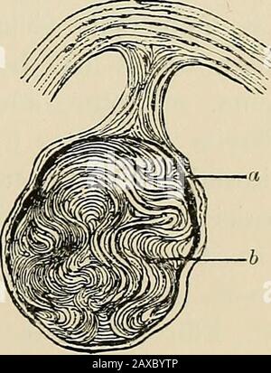 Die Pathologie und chirurgische Behandlung von Tumoren . Tische Adenomata und Chondromata. Die Langsamkeit des Wachstums muss als wichtiges Klinikalmerkmal eines gutartigen Tumors betrachtet werden. Jedes Benignwachstum wird durch eine begrenzende Kapsel surronndcd, die es von den angrenzenden Geweben trennt, und über die es sich nie erstreckt. Diese Isola aus den Siirroiinding-Geweben ist das mostdestitijictive anatomische Merkmal von benignen im Vergleich zu bösartigen Tumoren. Die Exexistenz dieser Bindegewebskapsel ist in der Mehrzahl der Fälle dazu da, den Chirurgen gutartige Tumore durch Enu-Spaltung zu entfernen. Wenn die Kapsel von Stockfoto