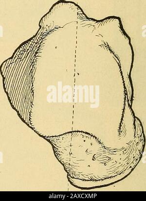 Vorträge zur orthopädischen Chirurgie . Abb. 239 - Normaler Astragalus. Showingrelation der Halsachse zur tibialartikulären Oberfläche. Abb. 240.-Deformierter Astragalus aus der Akase des angeborenen Äquinovarus. Zeigt eine Verformung des Halses in der Rela-tion zur tibialen Gelenkfläche. Diese Theorie wurde von H. W. Berg, New York, entwickelt und in ihre Logikfolgen übertragen. Er sagt: Sobald die Gelenke gebildet sind, finden wir die Oberschenkel so weit wie möglich ausgedreht und auf den Körper gebeugt. Das Bein ist auf den Oberschenkel gebeugt, aber nicht vollständig, denn dies wird durch die extreme Drehung des Oberschenkels verhindert, die den inn bringt Stockfoto