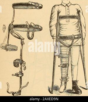 Vorträge zur orthopädischen Chirurgie . Abb. 110.-Der Shhaflfer Hüftsplint. Abb. 111.-Die lange Bewegungs-Hüft-Splint-Behandlung von Eidlon, von der angenommen wurde, dass sie Bewegung mit außtreibenden Reibungen zulässt, wurde als amerikanische Methode ^der Behandlung bekannt. Es ist vielleicht nicht notwendig zu sagen, dass die Prinzipien, auf denen diese Behandlung beruht, vom Beruf aufgegeben wurden. Die Traktion, die von einer mechanischen Vorrichtung mit 151, die als Hüftsplint mit langer Traktion bekannt ist, erhalten wird, wird immer noch sowohl während der Liege- als auch während der Fortbewegung verwendet, wird aber nicht mehr mit der Idee verwendet, dass Bewegung ohne Reibung eine mechanische Possib ist Stockfoto